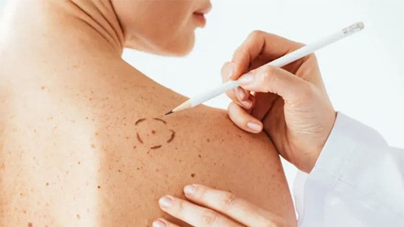 Verano y exposición al sol: en el Día Mundial contra el Cáncer, consejos y prevención