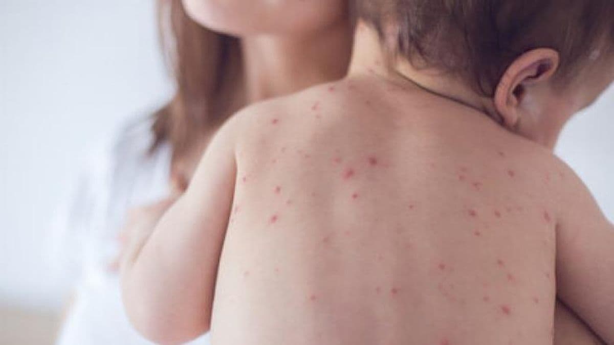 Brote activo de sarampión: Instan a recibir la dosis de refuerzo