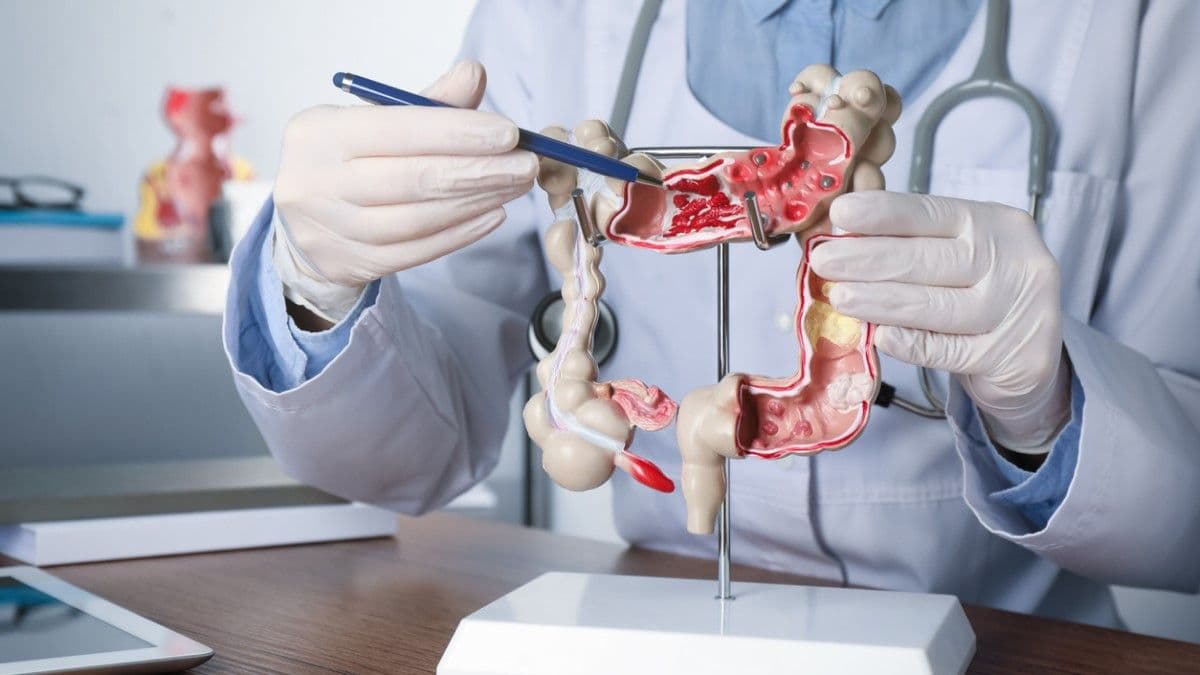 Marzo azul: el cáncer de colon, una enfermedad frecuente pero altamente prevenible