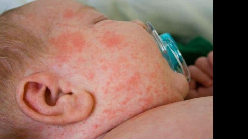 Sarampión: niños de entre 6 y 11 meses deben vacunarse; aún no en Pergamino
