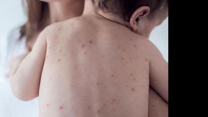 Sarampión: confirman nuevos casos y varios en la Provincia