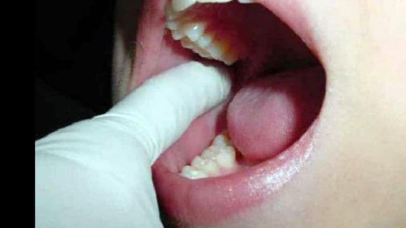 Preocupa el incremento de casos de cáncer bucal