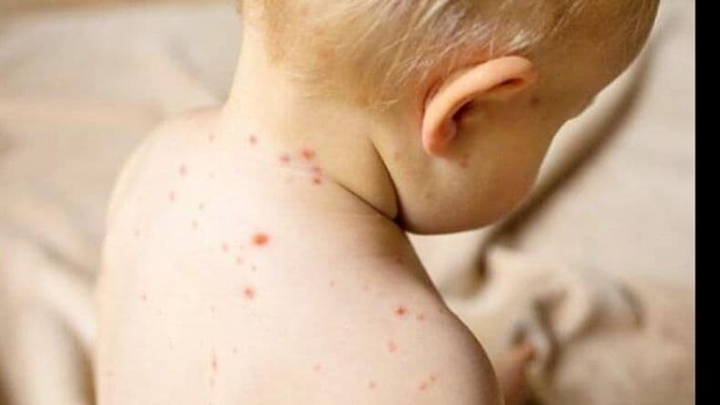 Nueva variante de sarampión produce falsos negativos y es difícil de detectar