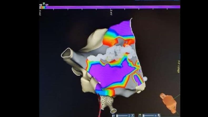 Clínica Pergamino: se realizó un innovador procedimiento para tratar una arritmia compleja