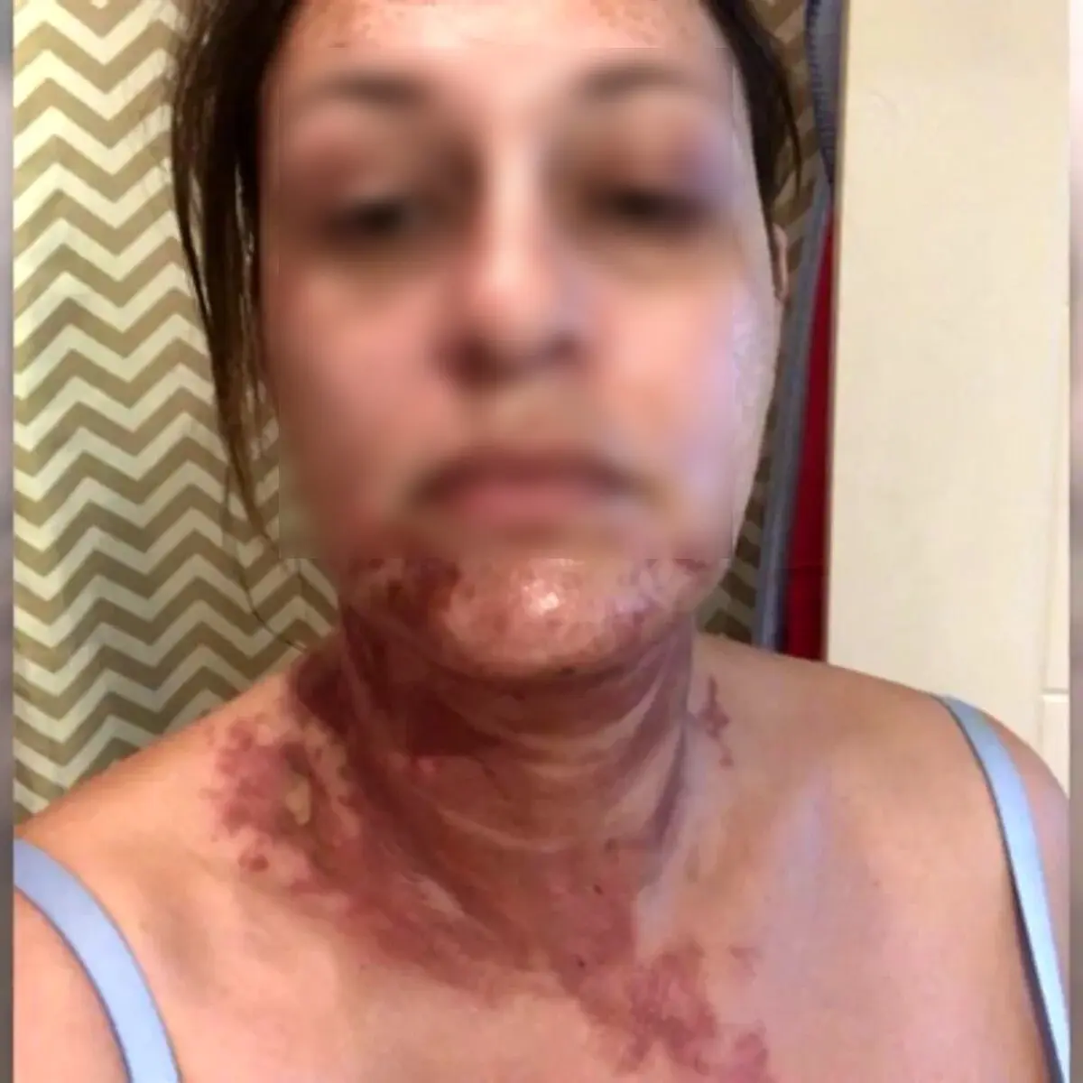 Una mujer sufrió quemaduras en el rostro durante un incendio en una vivienda del barrio Acevedo